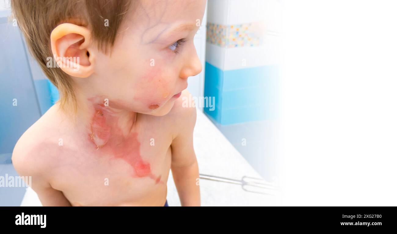 vestire un ragazzo con una scottatura dovuta all'acqua bollente Foto Stock