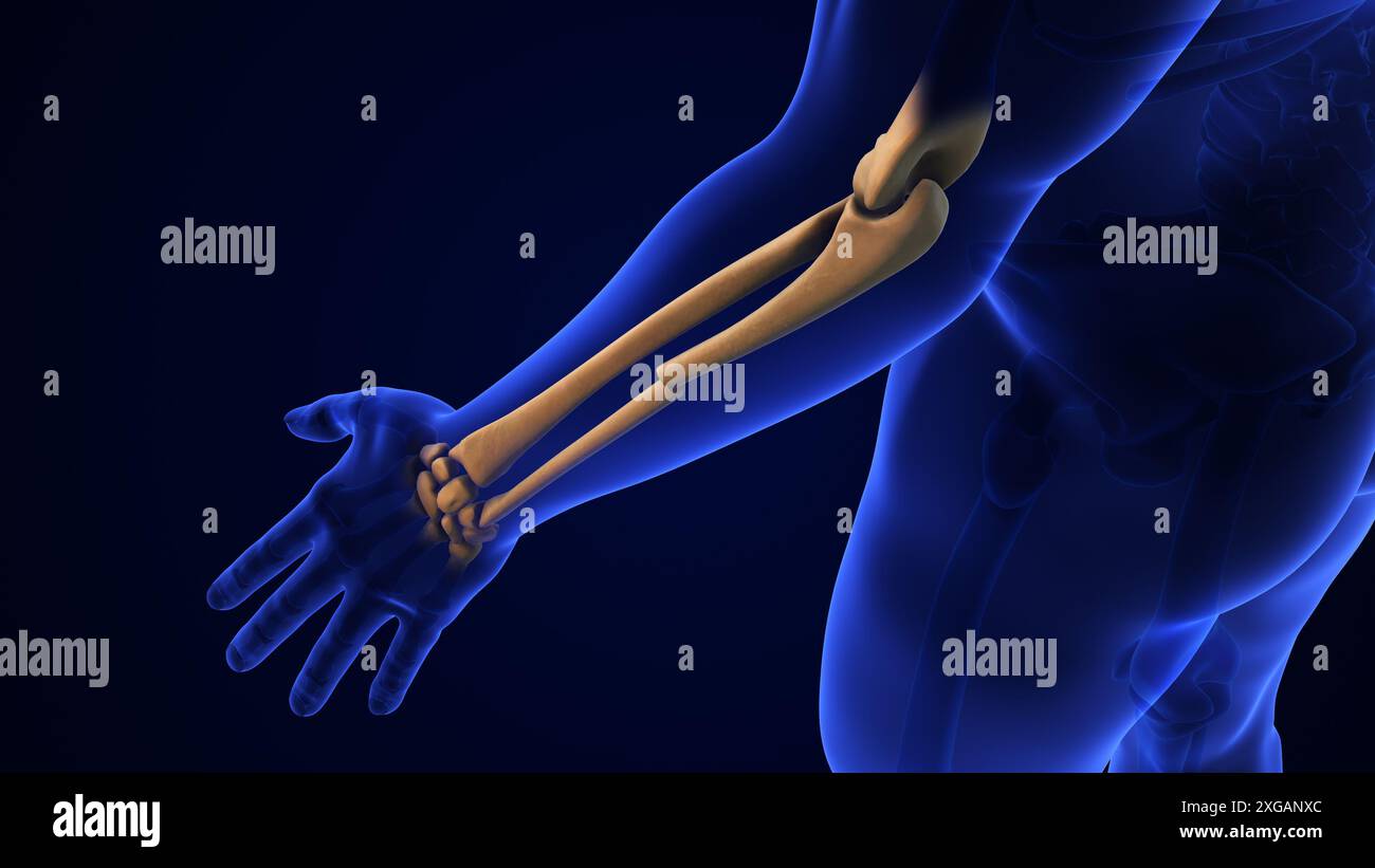 Concetto medico Broken Ulna Bone Foto Stock