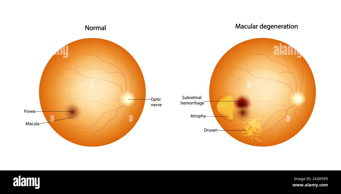 Retina normale e degenerazione maculare Drusen, atrofia, emorragia subretinica. Illustrazione Vettoriale