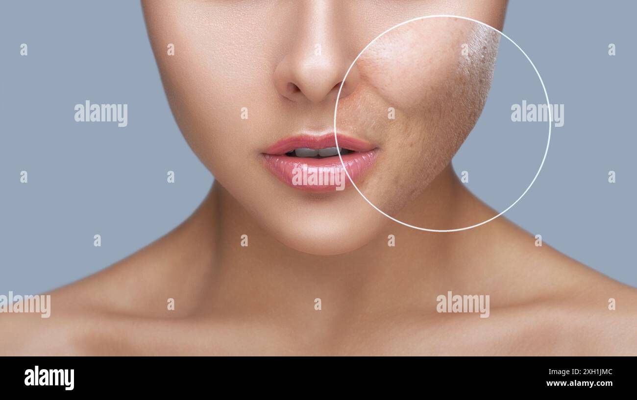 Una giovane ragazza con un problema alla pelle. Foto prima e dopo il trattamento per l'acne. Trattamenti per la pelle, trattamenti spa. Foto Stock