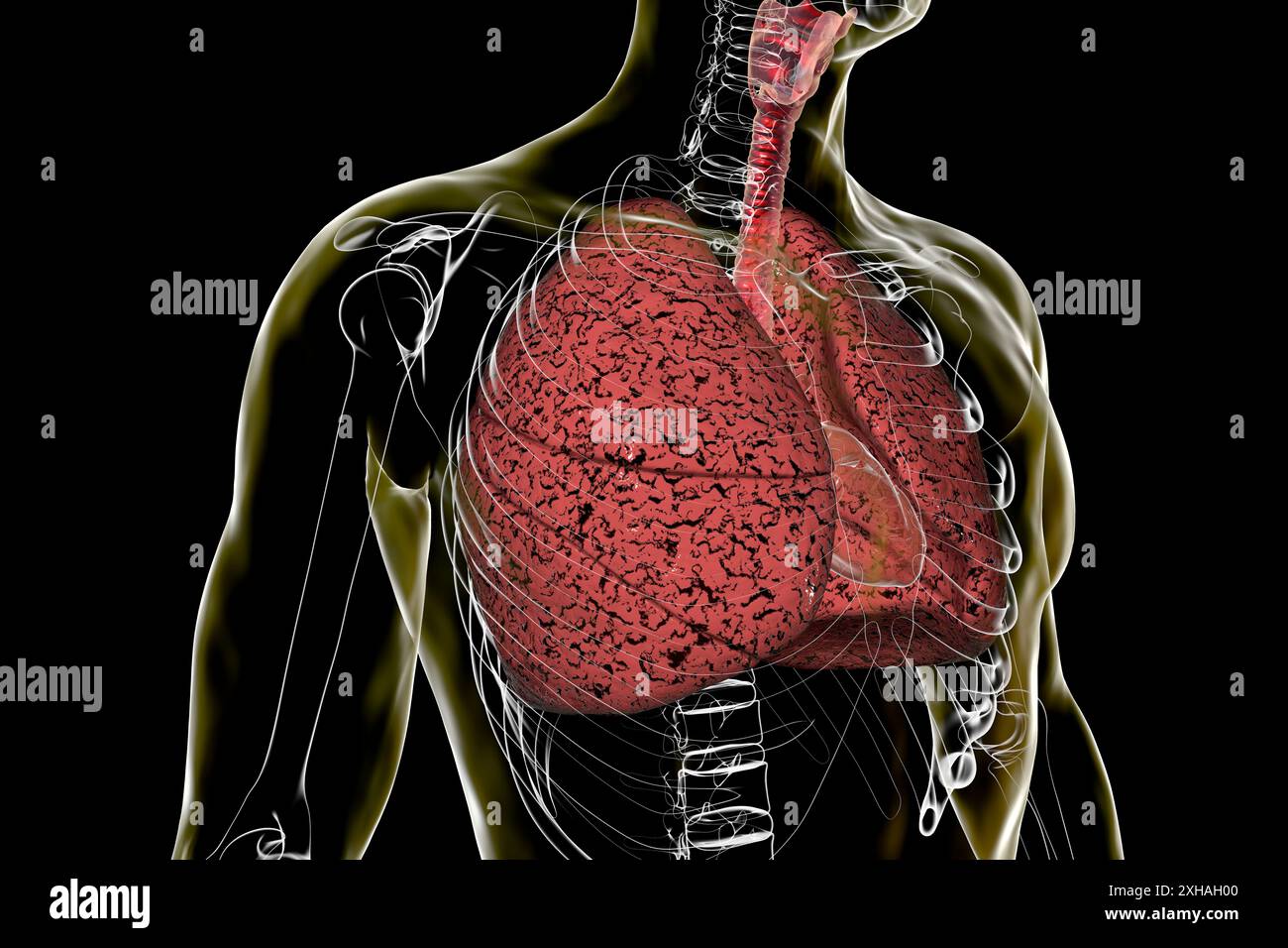 Illustrazione di polmoni influenzati dal fumo. Foto Stock