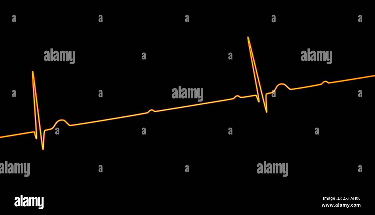 Immagine di un elettrocardiogramma (ECG) che raffigura un blocco cardiaco completo (terzo blocco atrioventricolare). L'ECG mostra una dissociazione completa tra il ritmo atriale e quello ventricolare. Foto Stock