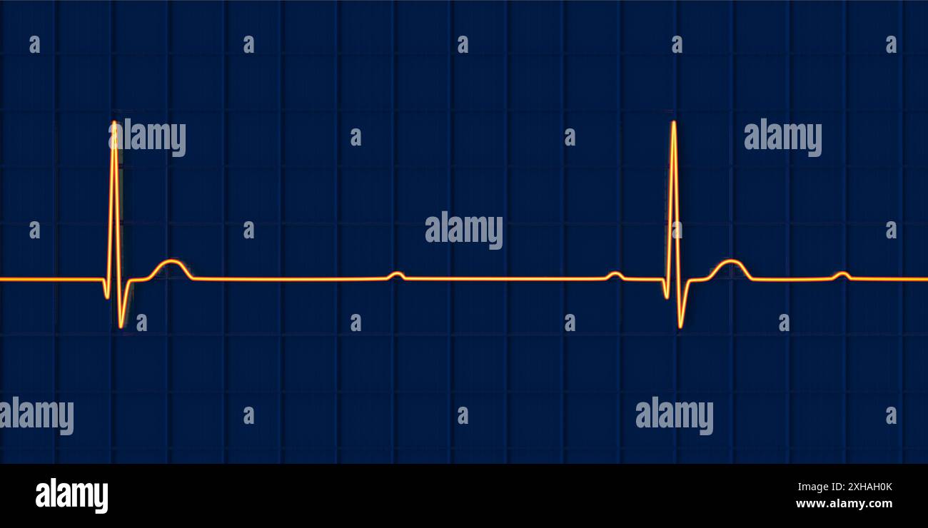 Immagine di un elettrocardiogramma (ECG) che raffigura un blocco cardiaco completo (terzo blocco atrioventricolare). L'ECG mostra una dissociazione completa tra il ritmo atriale e quello ventricolare. Foto Stock