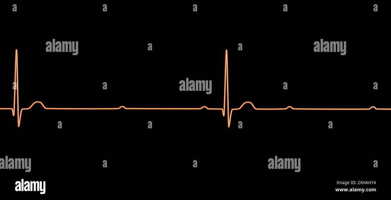 Immagine di un elettrocardiogramma (ECG) che raffigura un blocco cardiaco completo (terzo blocco atrioventricolare). L'ECG mostra una dissociazione completa tra il ritmo atriale e quello ventricolare. Foto Stock