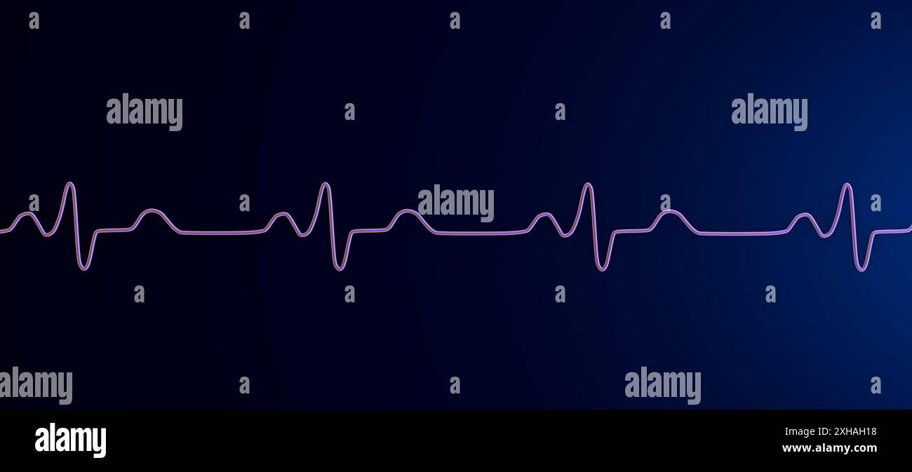 Immagine di un elettrocardiogramma (ECG) che raffigura un blocco di branca. Ciò si verifica quando qualcosa blocca o interrompe il segnale elettrico che fa battere il cuore. L'ECG mostra complessi QRS ampliati e depolarizzazione ventricolare alterata. Foto Stock