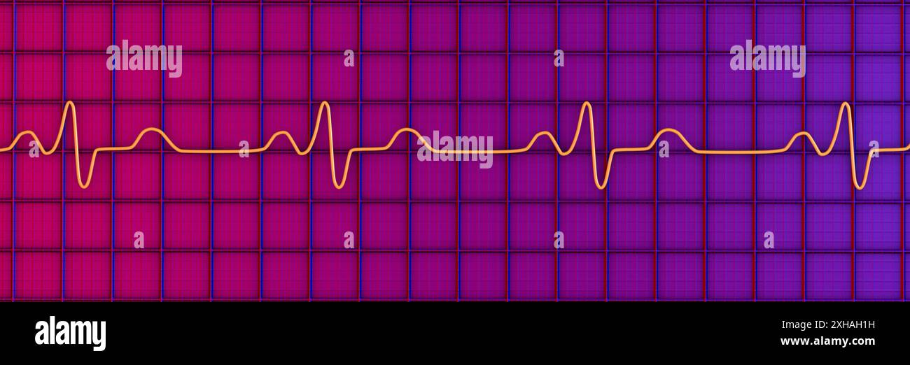 Immagine di un elettrocardiogramma (ECG) che raffigura un blocco di branca. Ciò si verifica quando qualcosa blocca o interrompe il segnale elettrico che fa battere il cuore. L'ECG mostra complessi QRS ampliati e depolarizzazione ventricolare alterata. Foto Stock