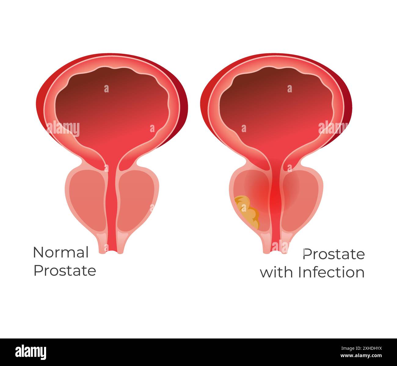 Prostata normale e ghiandola prostatica con infezione - illustrazione di scorta come file EPS 10 Illustrazione Vettoriale