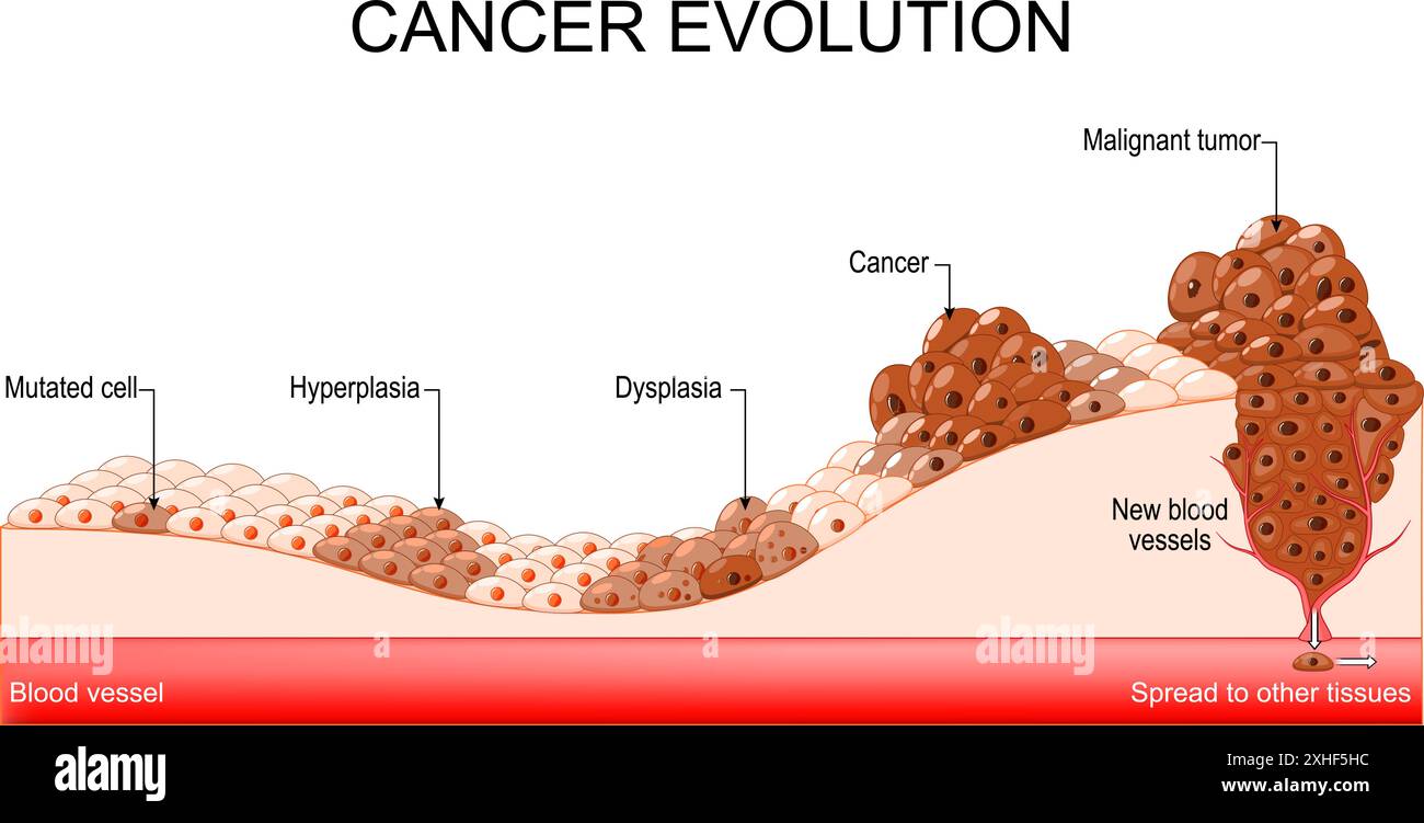 Evoluzione del cancro da cellule mutate e iperplasia, a displasia e tumore maligno. Diffondere le cellule tumorali ad altri tessuti. Diagramma vettoriale Illustrazione Vettoriale