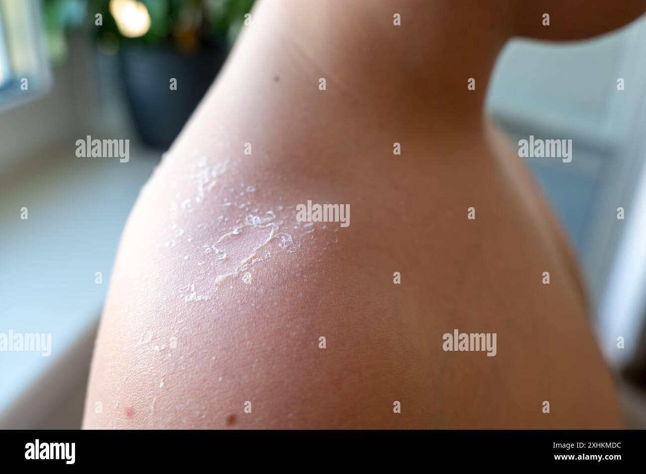 Spalla del bambino bruciato al sole mostra peeling della pelle, segno comune di danni al sole Foto Stock