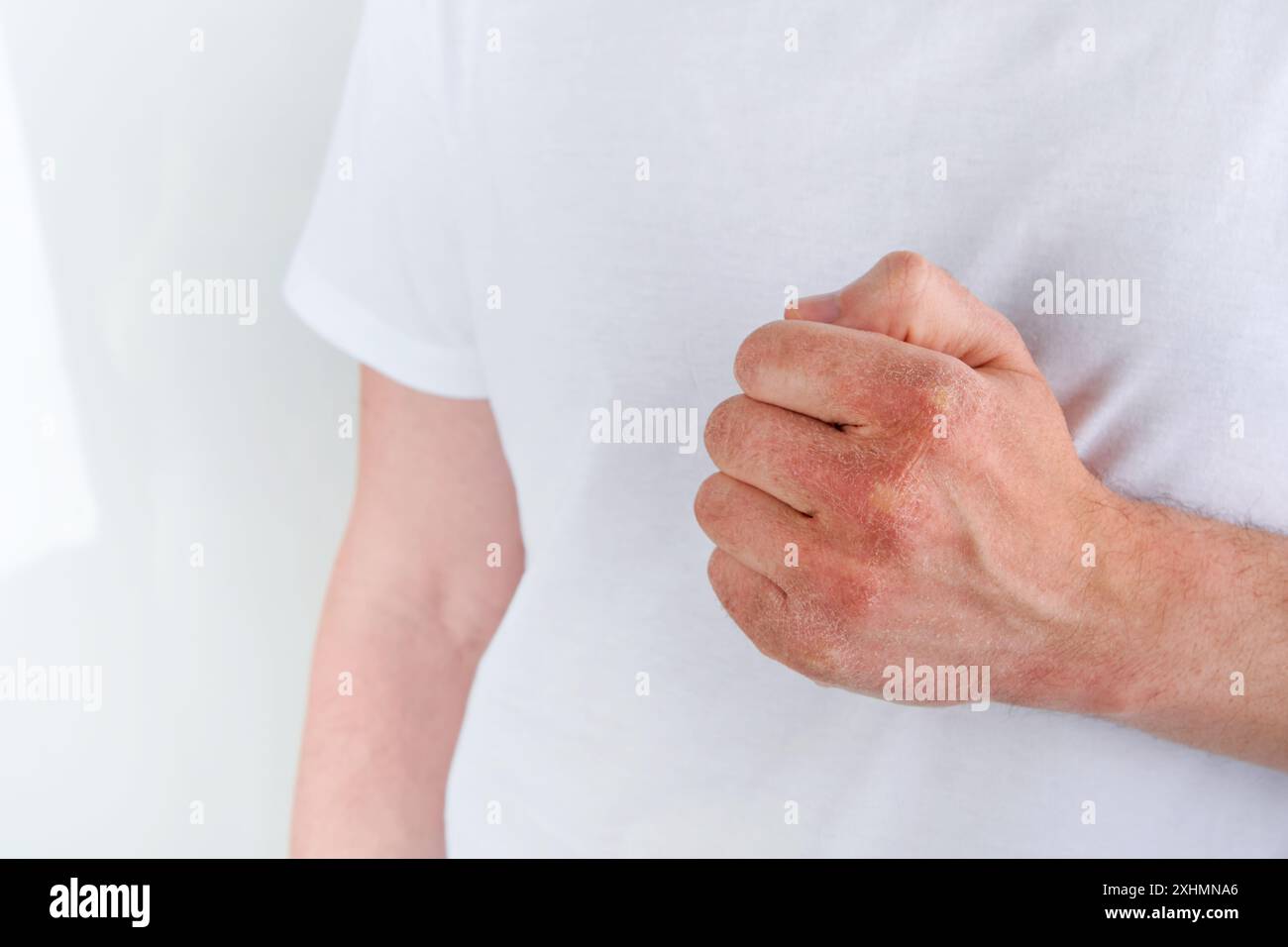 L'uomo graffia o mostra le mani con la pelle asciutta e incrinata su sfondi bianchi. Problema con molte persone - eczema a portata di mano, allergie o pelle secca. Auto sanitaria Foto Stock