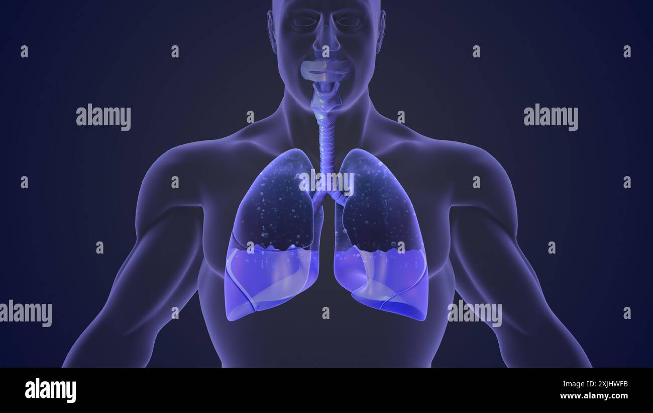 L'effusione pleurica rappresenta uno smaltimento inadeguato Foto Stock