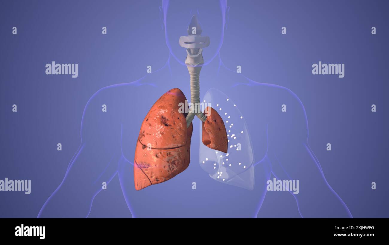 Concetto medico della malattia dello pneumotorace polmonare Foto Stock