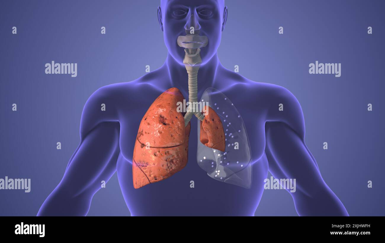 Concetto medico della malattia dello pneumotorace polmonare Foto Stock
