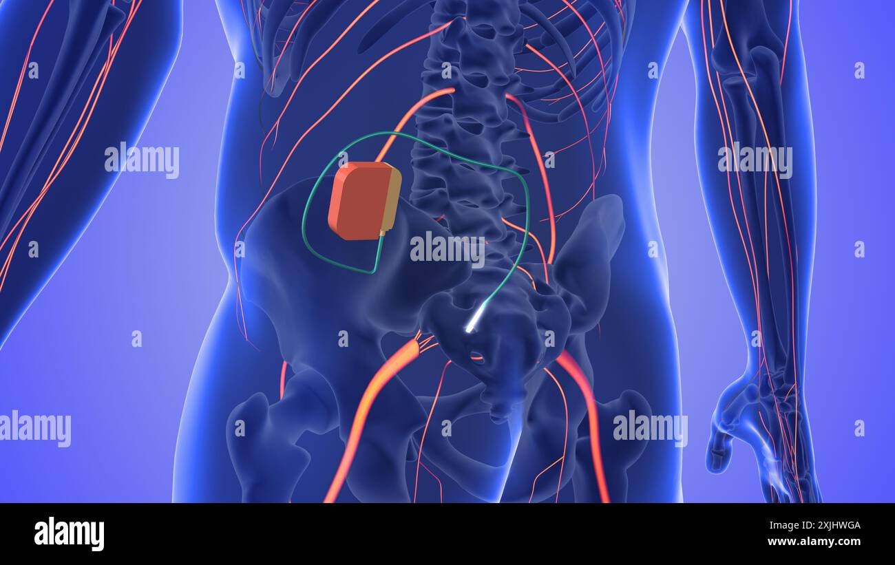 Concetto medico di stimolazione del nervo sacrale Foto Stock