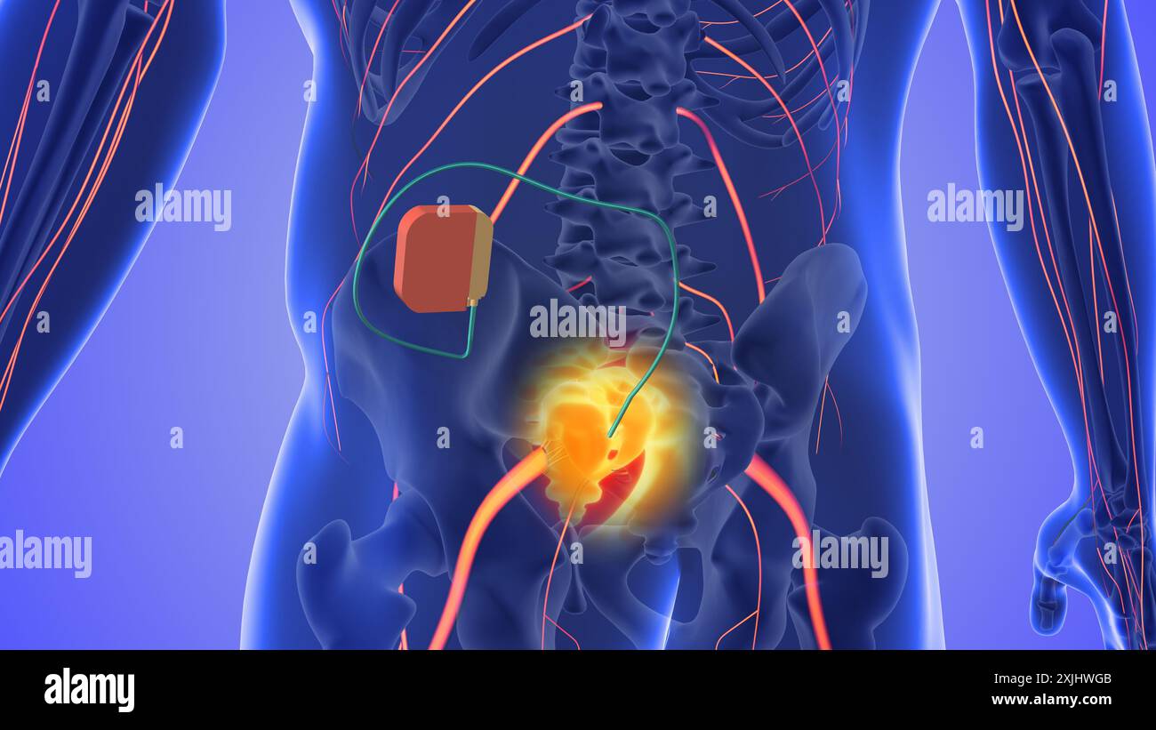Concetto medico di stimolazione del nervo sacrale Foto Stock