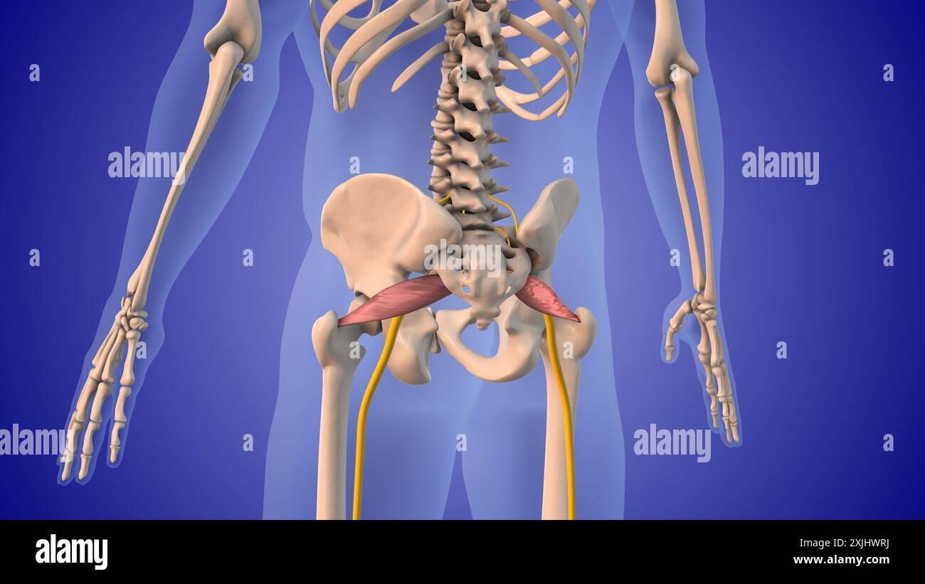 Iniettare steroidi per trattare la sindrome di Piriformis Foto Stock