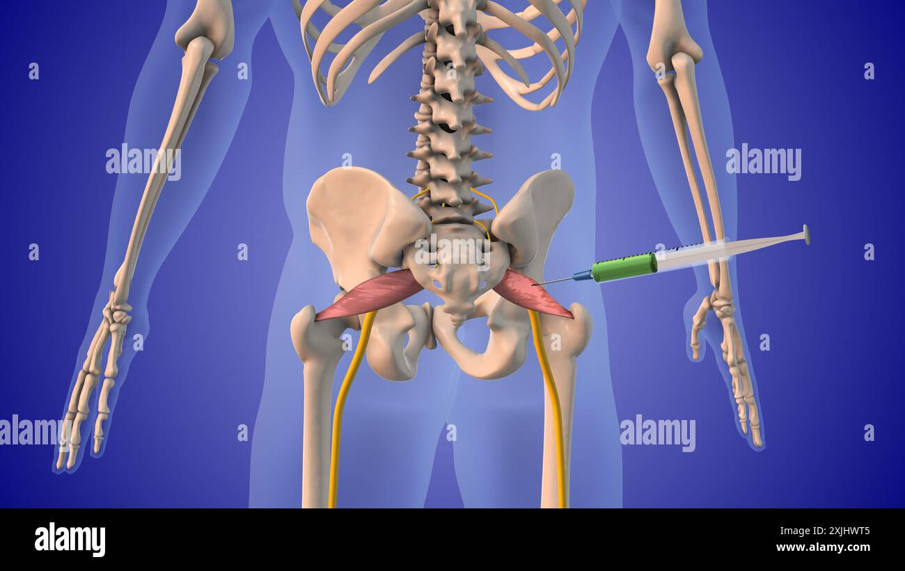 Iniettare steroidi per trattare la sindrome di Piriformis Foto Stock