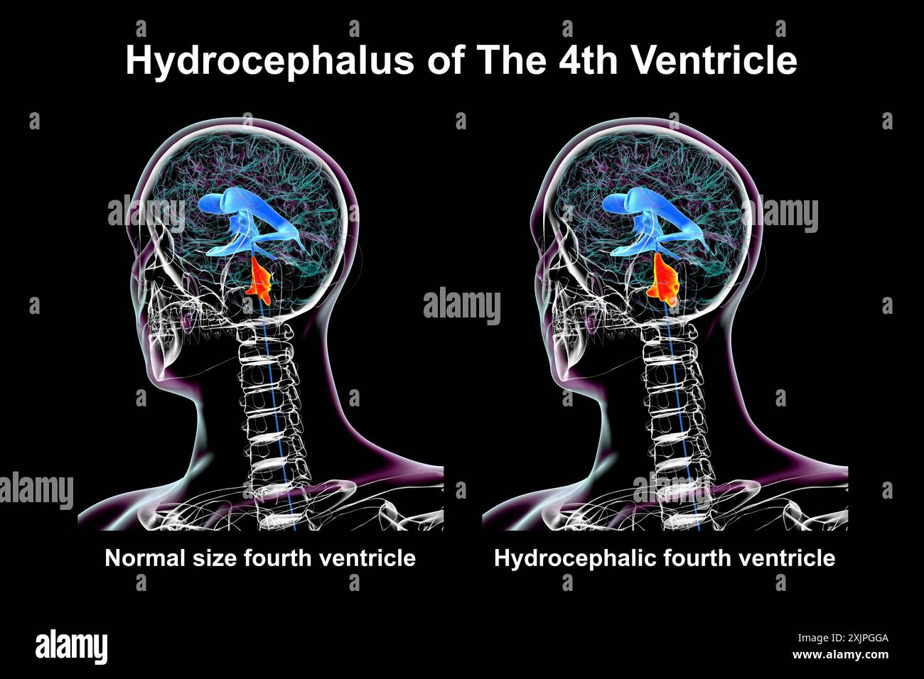 Illustrazione che raffigura un ingrandimento isolato del quarto ventricolo cerebrale (destro) rispetto al quarto ventricolo di dimensioni normali (sinistro). Foto Stock