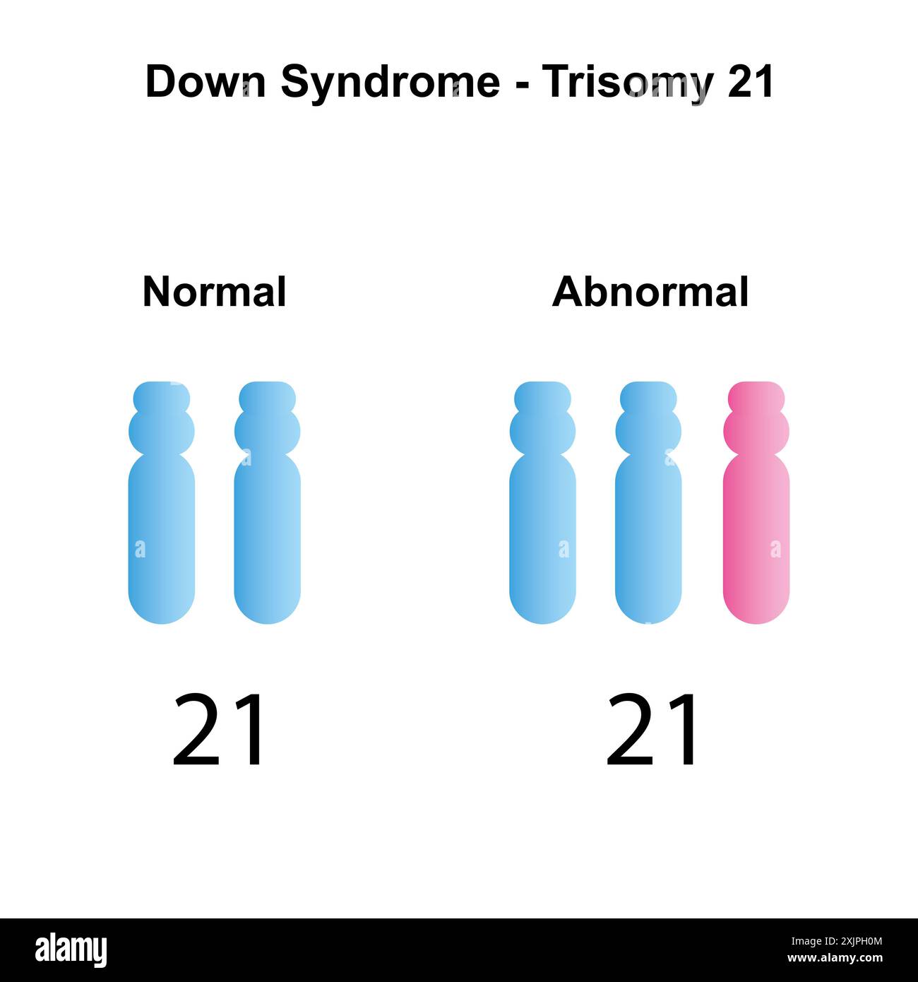 Sindrome della trisomia 21, illustrazione. Foto Stock