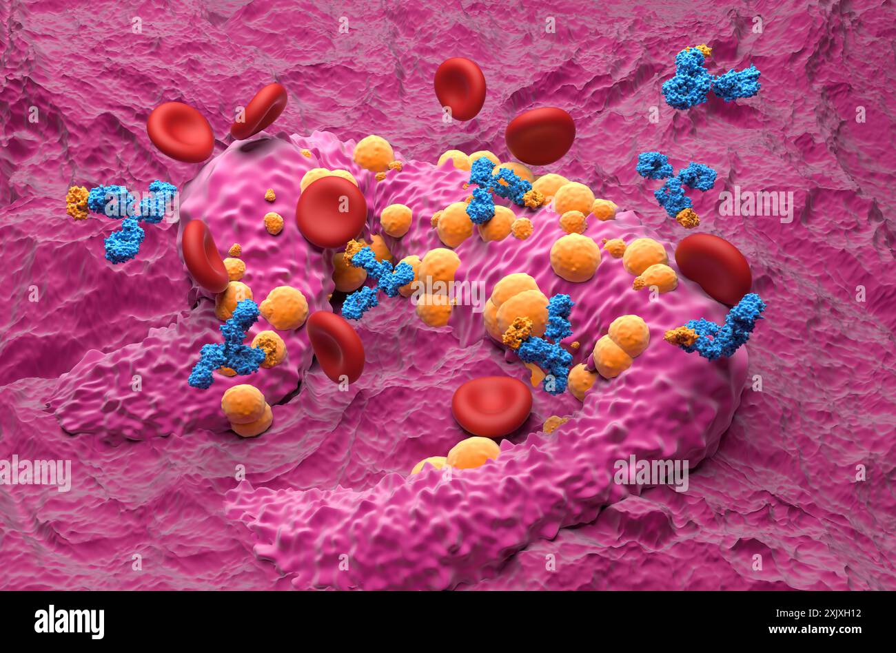 Trattamento con anticorpi monoclonali nel carcinoma basocellulare (BCC) - Vista isometrica illustrazione 3d. Foto Stock