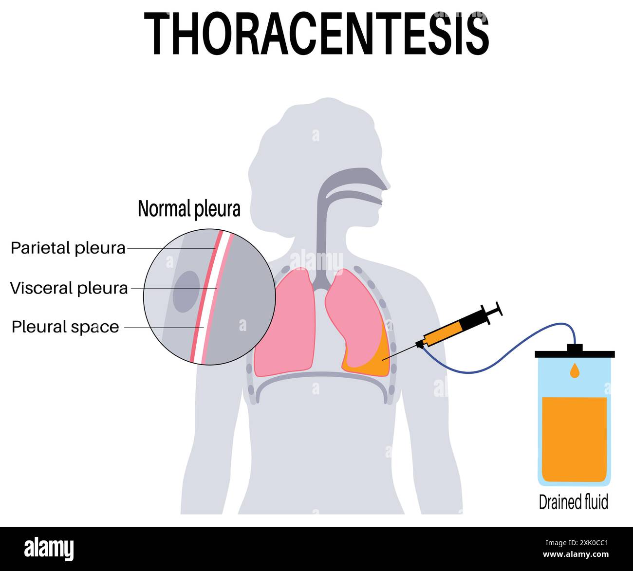 Poster medico della procedura di toracentesi: Incisione della parete toracica per la rimozione di liquidi, polmoni non sani, illustrazione del vettore malattia del sistema respiratorio Illustrazione Vettoriale Poster medico della procedura di toracentesi: Incisione della parete toracica per la rimozione di liquidi, polmoni non sani, illustrazione del vettore malattia del sistema respiratorio Illustrazione Vettoriale