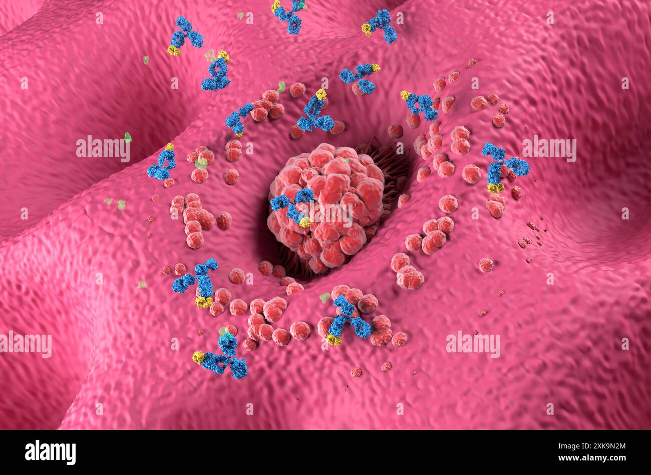 Trattamento con anticorpi monoclonali nel cancro dello stomaco (gastrico) - Vista isometrica illustrazione 3d. Foto Stock