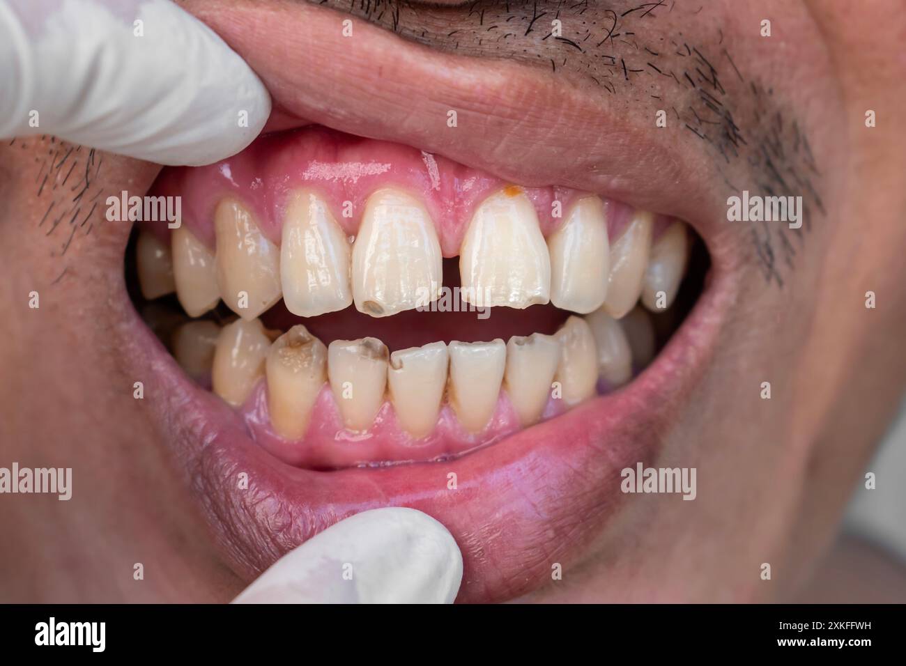 Enorme spazio tra i denti anteriori o gli incisori dell'uomo cinese asiatico. Diastema. Denti incrinati o scheggiati. Foto Stock