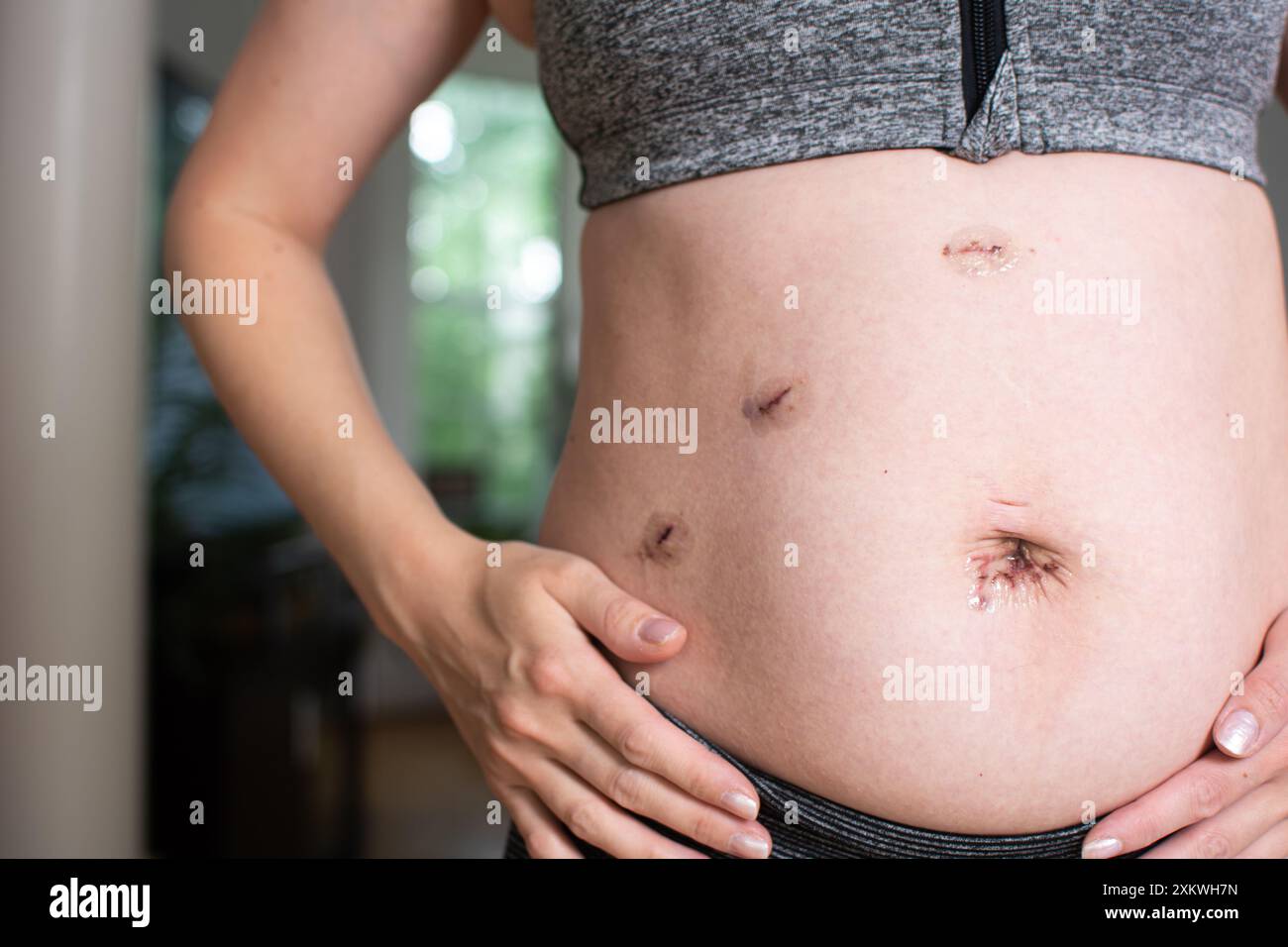 Cicatrici da intervento chirurgico di colecistectomia laparoscopica. Intervento chirurgico di rimozione della colecisti Foto Stock