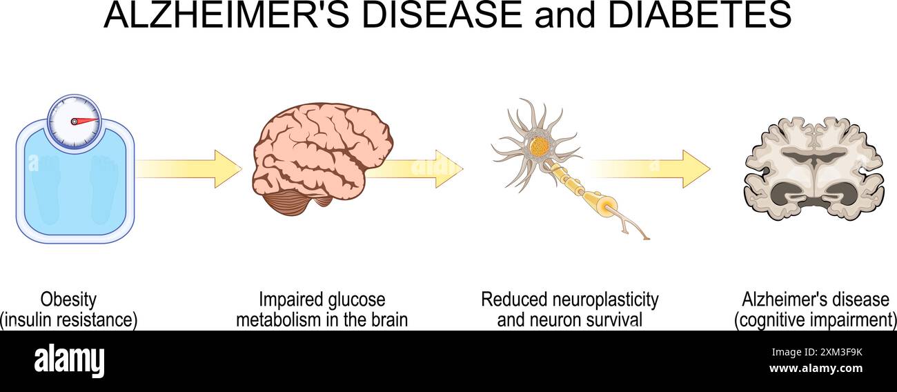 Diabete e malattia di Alzheimer progressione. Dall'obesità, alla resistenza all'insulina, al declino cognitivo e all'Alzheimer. illustrazione vettoriale Illustrazione Vettoriale