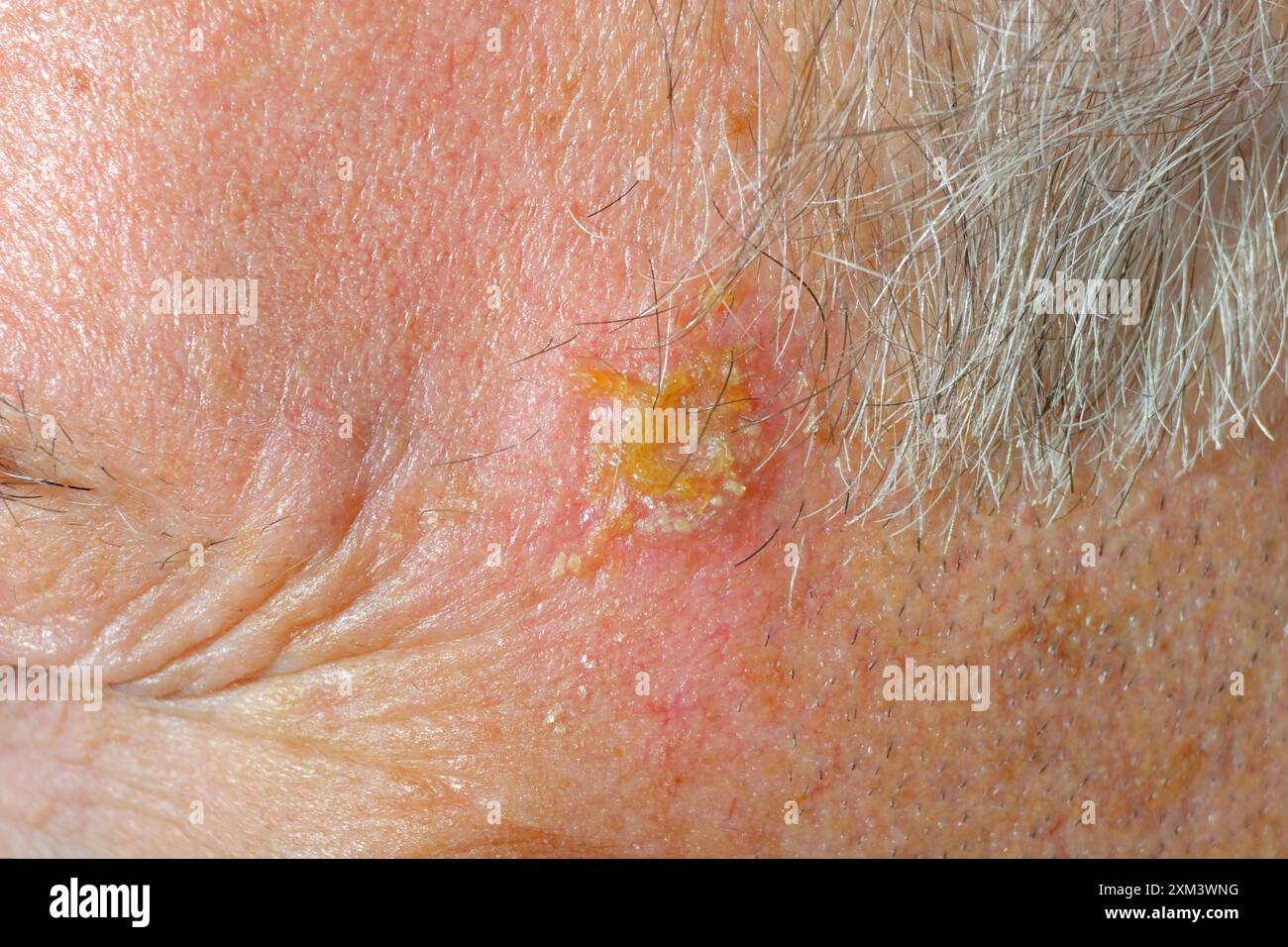 Le cheratosi attiniche si irritano 24 ore dopo un trattamento di crioterapia. Foto Stock