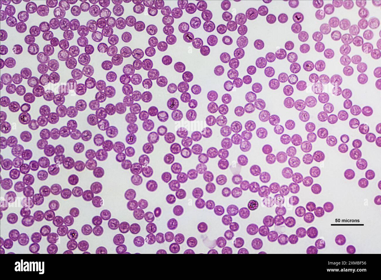 Cellule ematiche umane sotto microscopio leggero, colorate con colorazione Giemsa per ingrandimento di 40 volte Foto Stock