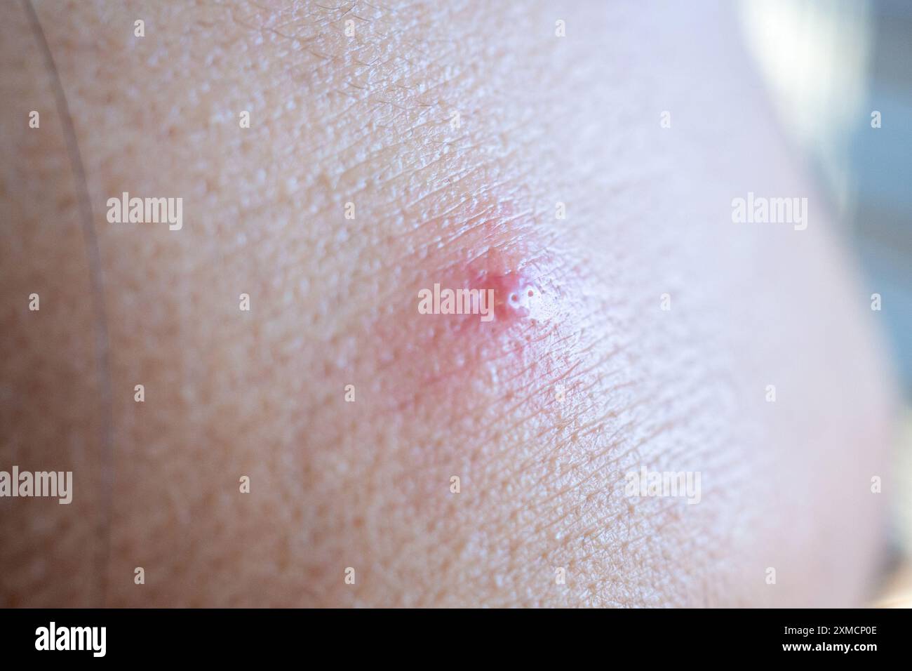 Acne infiammatoria con macchia rossa sul primo piano del viso Foto Stock