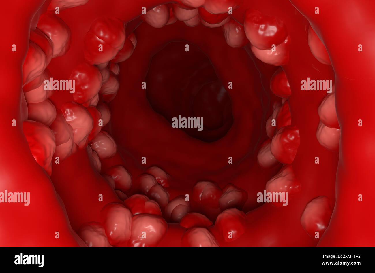 Colite ulcerosa (UC) - Vista in sezione illustrazione 3d. Foto Stock