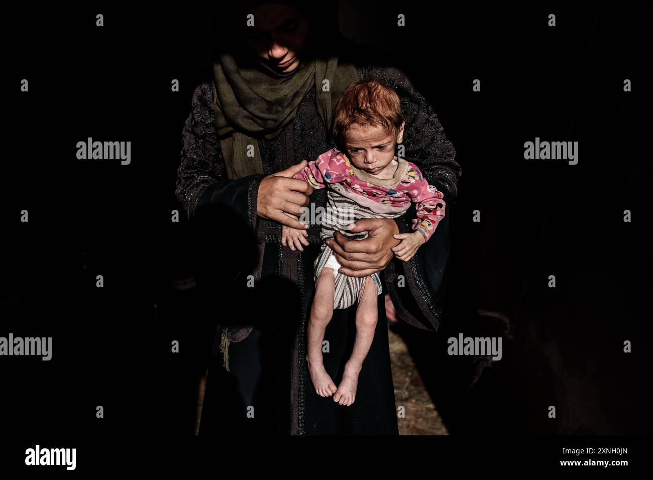 30 luglio 2024, Siria, Atimah: Il bambino Marwan Shahen, di 7 mesi, soffre di grave malnutrizione. I residenti nei campi nella Siria nord-occidentale stanno subendo condizioni umanitarie terribili a causa della mancanza di finanziamenti, che ha portato alla cessazione delle distribuzioni di panieri alimentari nella maggior parte dei campi e a un aumento dei casi di malnutrizione nel 2024 rispetto agli anni precedenti. Secondo un rapporto dell'OCHA, il 50 per cento delle strutture sanitarie cesserà di funzionare completamente o parzialmente entro dicembre, e il numero di persone che soffrono di insicurezza alimentare ha raggiunto i 3,6 milioni. Foto: Anas Alkharboutli/dpa Foto Stock