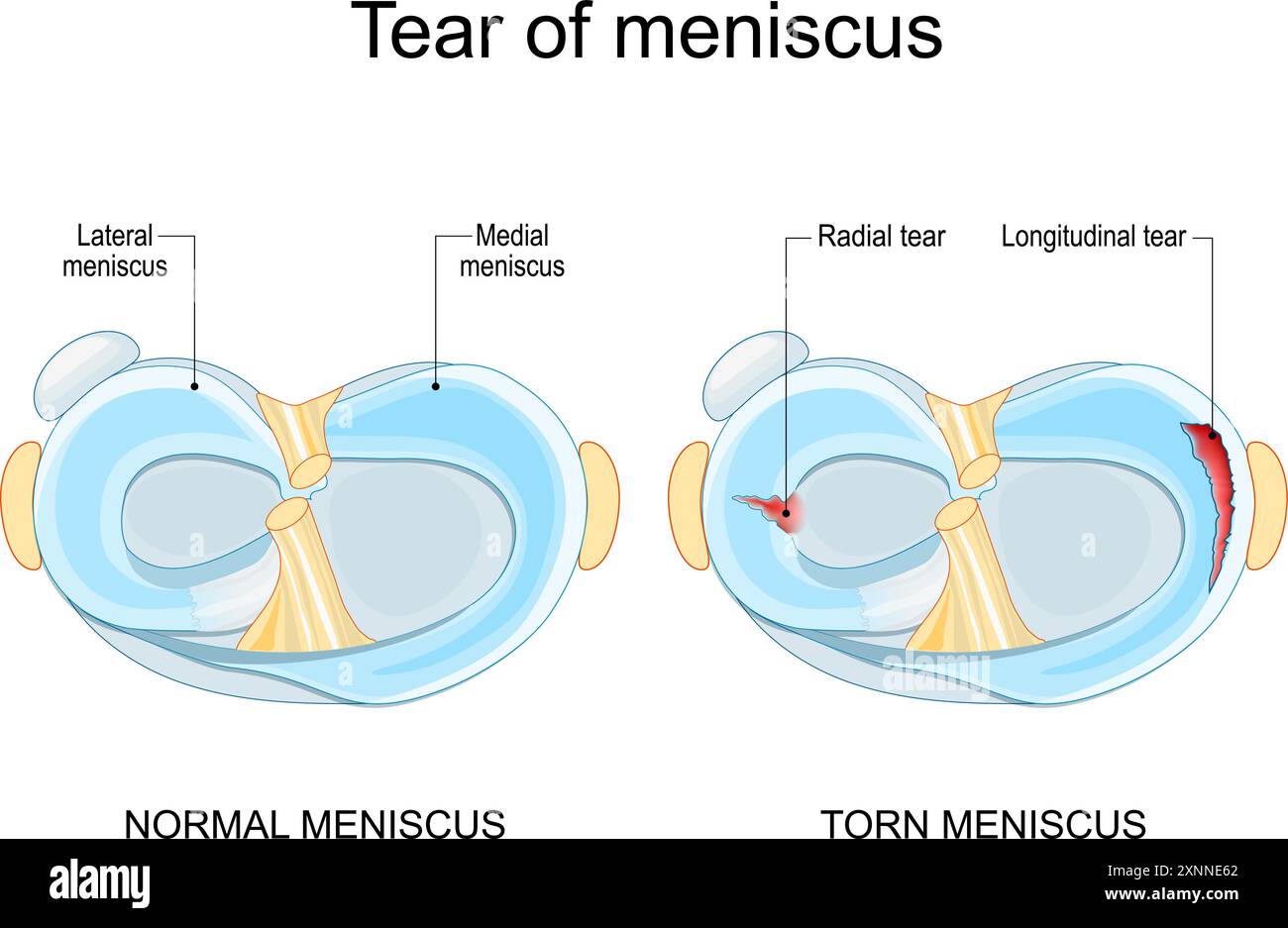 Lacerazione meniscale. Menisco lacerato. Lesione al ginocchio. Danni alla cartilagine. Riparazione del menisco. Infortunio sportivo. Testa della tibia vista dall'alto. Illustrazione vettoriale Illustrazione Vettoriale