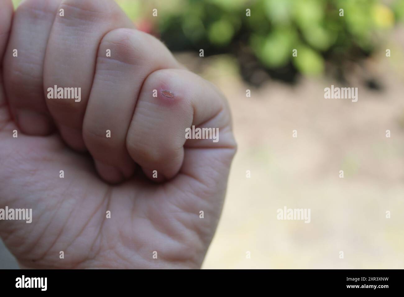 Un richiamo su un dito da vicino. Mani che richiedono cure. Foto Stock