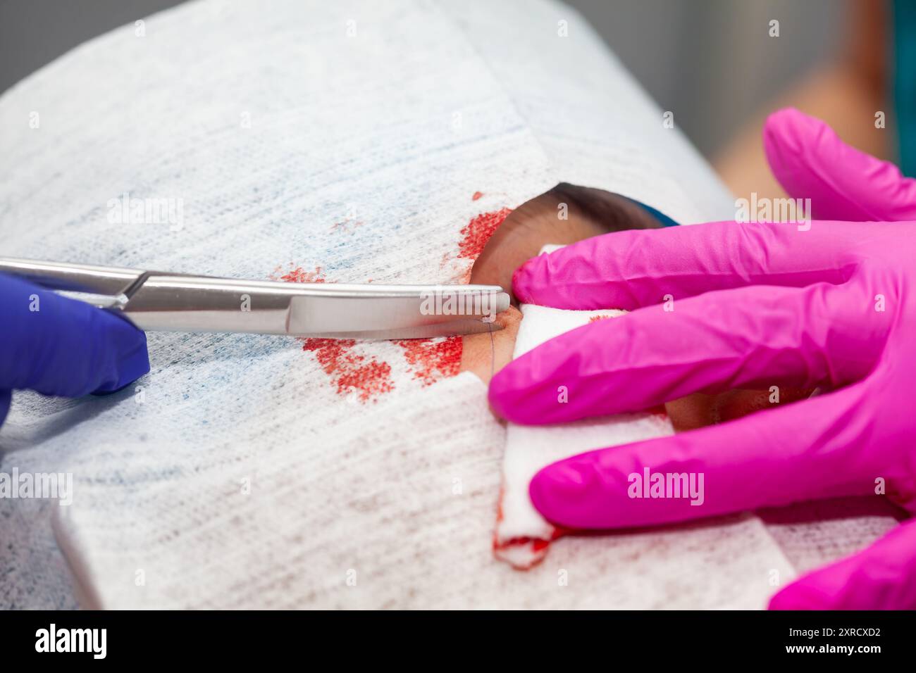 Medico che sutura un paziente durante un piccolo intervento chirurgico. Dermatologo che esegue una rimozione di lesione cutanea benigna sul viso di un giovane paziente di sesso maschile. Foto Stock