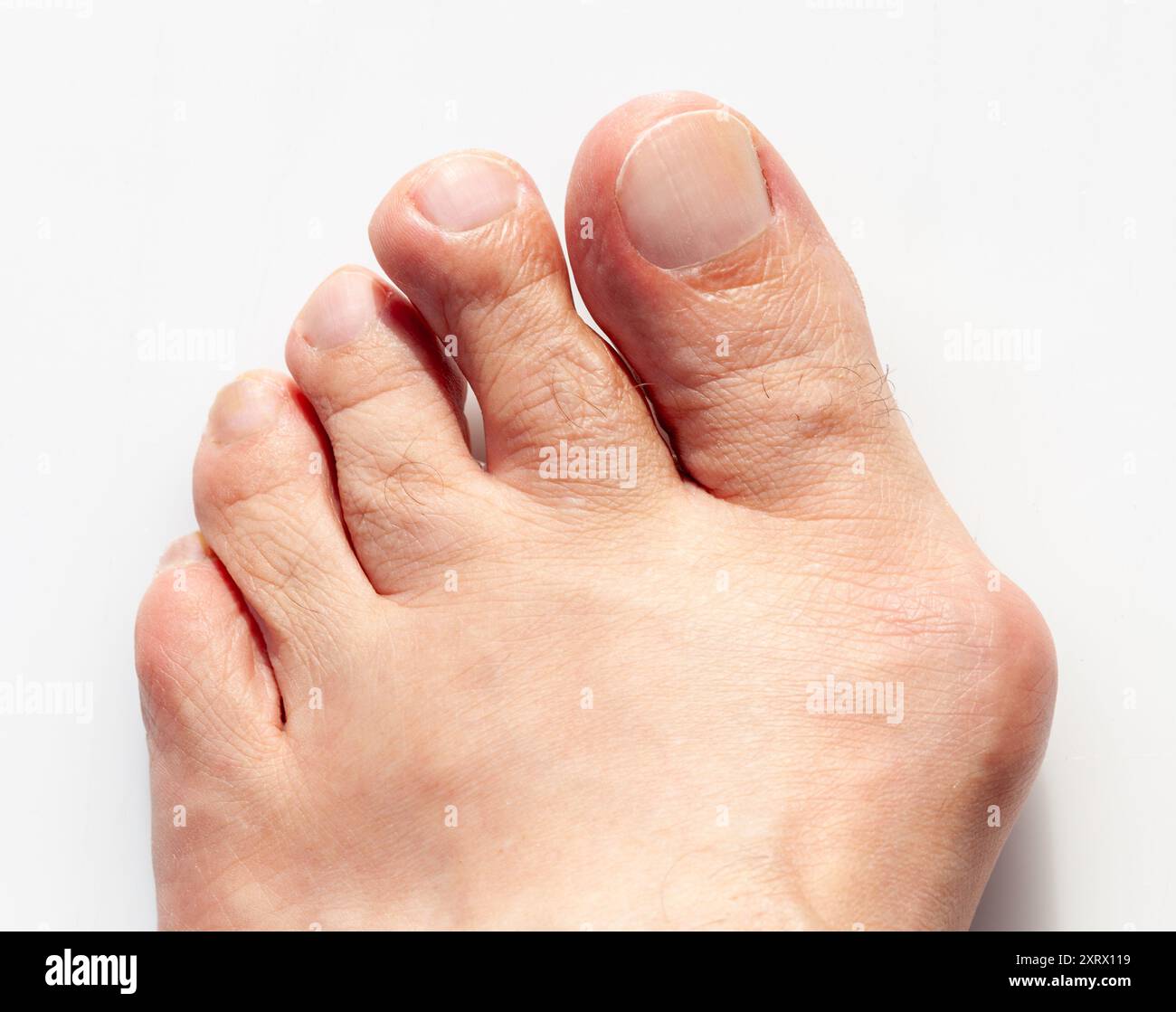 Vista dettagliata delle dita dei piedi influenzate dal bunion (allux valgus), che mostra l'angolo verso l'interno e la struttura sovrapposta. Rilevanza medica, anatomica, podiatrica. Foto Stock