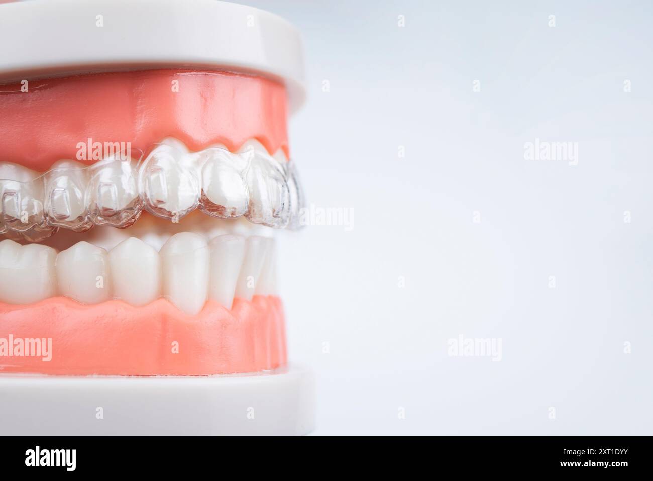 Cure dentistiche. Gli allineatori sono collocati su un modello artificiale di una mascella umana. Foto Stock