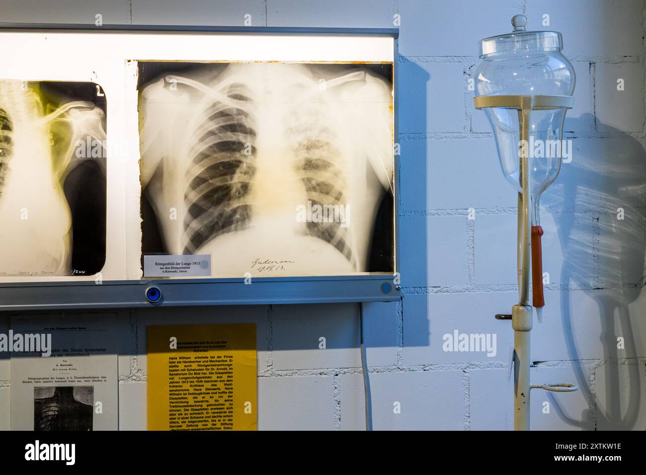 Vecchi raggi X di un polmone danneggiato dalla tubercolosi nel Davos Medical Museum. Immagini a raggi X e flacone per infusione al Davos Medicine Museum. Promenade, Davos, Grigioni, Grigioni, Svizzera Foto Stock