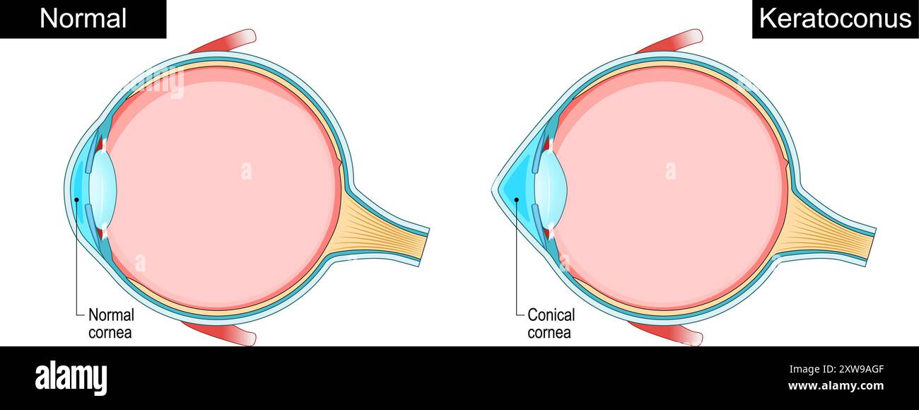 Cheratocono. Disturbo dell'occhio. Diradamento della cornea. Malattia progressiva dell'occhio. Astigmatismo. Cornea irregolare. Diagramma schematico. Illustrazione vettoriale dettagliata Illustrazione Vettoriale