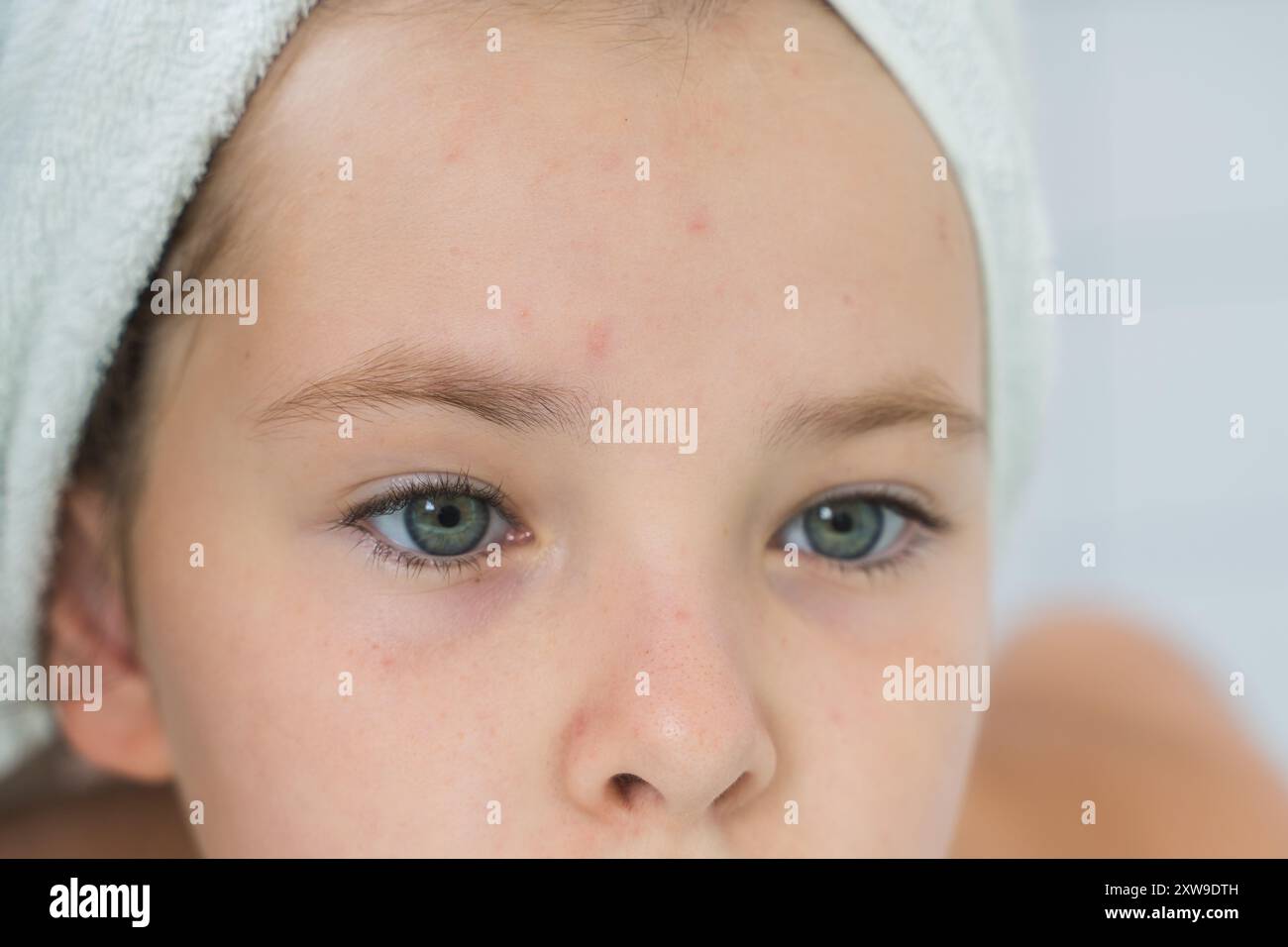 Piccola ragazza adolescente, guarda nello specchio, i primi brufoli sono apparsi sul suo volto. Problemi di pubertà. Foto di alta qualità Foto Stock