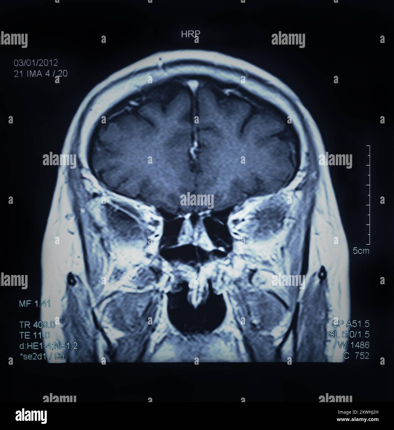 immagine di risonanza magnetica, scansione mri del cervello. Foto Stock