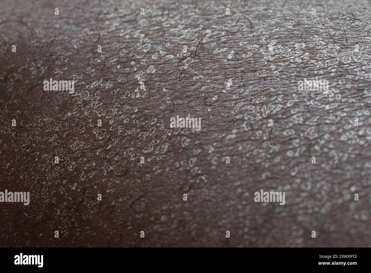 Pelle secca che mostra sintomi di malattia della pelle su persona di colore Foto Stock