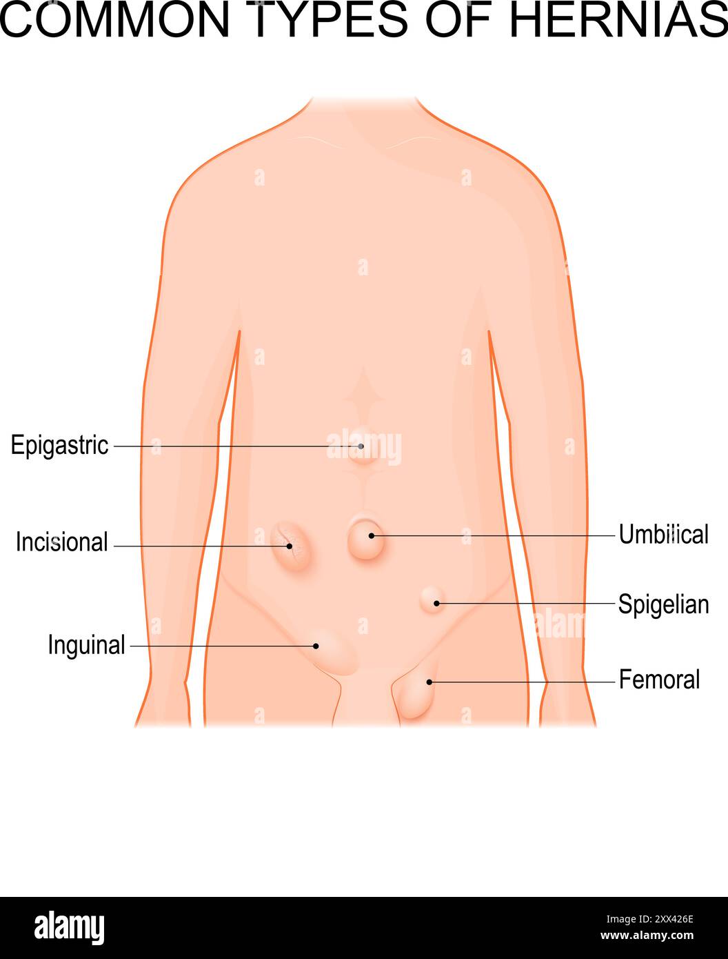 Tipi di ernia. Siti comuni per ernie. Diagramma schematico. Illustrazione vettoriale dettagliata Illustrazione Vettoriale