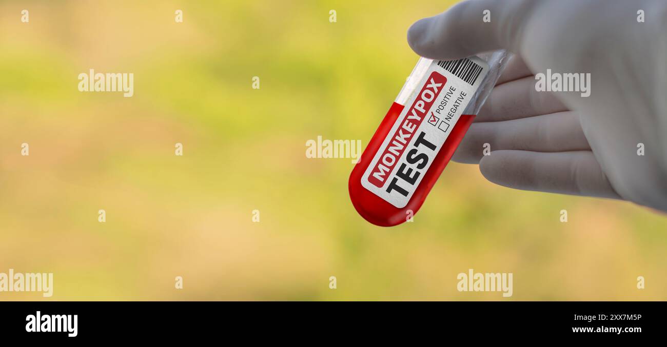 Test del sangue del virus Mpox Monkeypox. Medico in guanti bianchi in possesso di un campione di sangue per il virus Orthopoxvirus Mpox. Messa a fuoco selettiva di un vetro etichettato Foto Stock