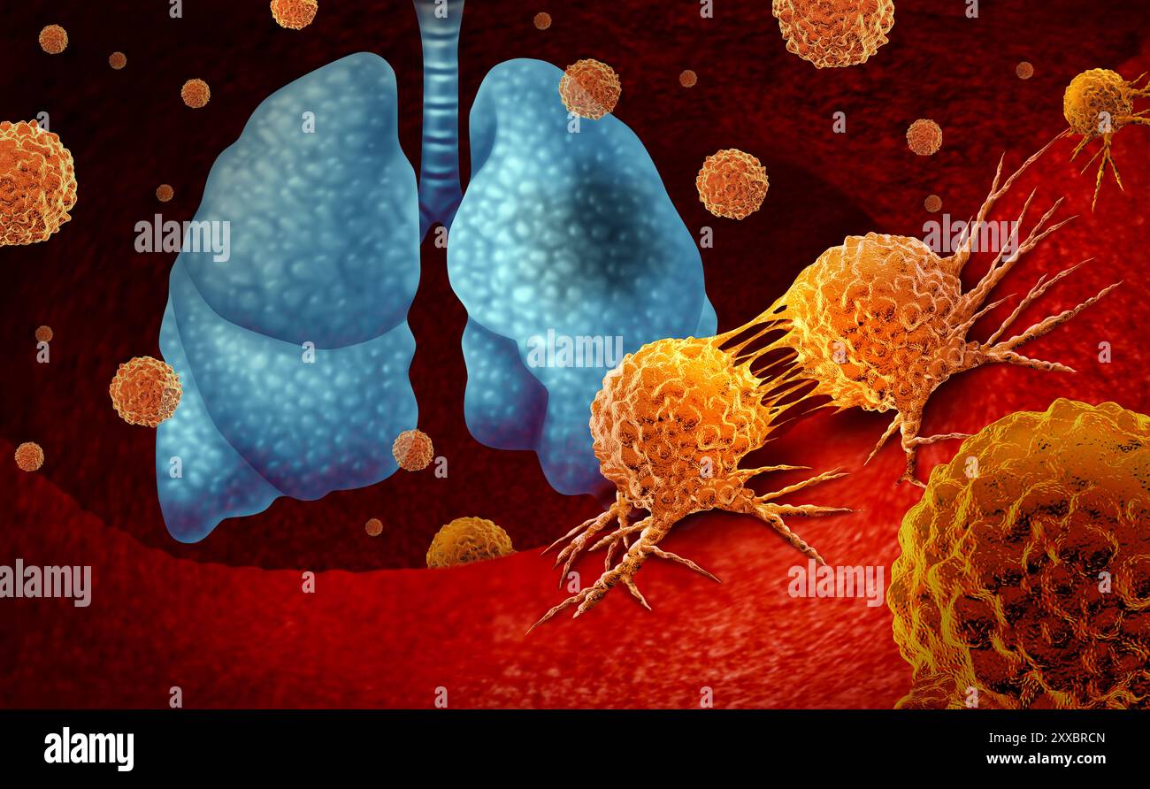 Diagnosi di cancro polmonare o carcinoma polmonare e sintomi della malattia polmonare umana concetto come un declino della funzione respiratoria causata da un tumore. Foto Stock