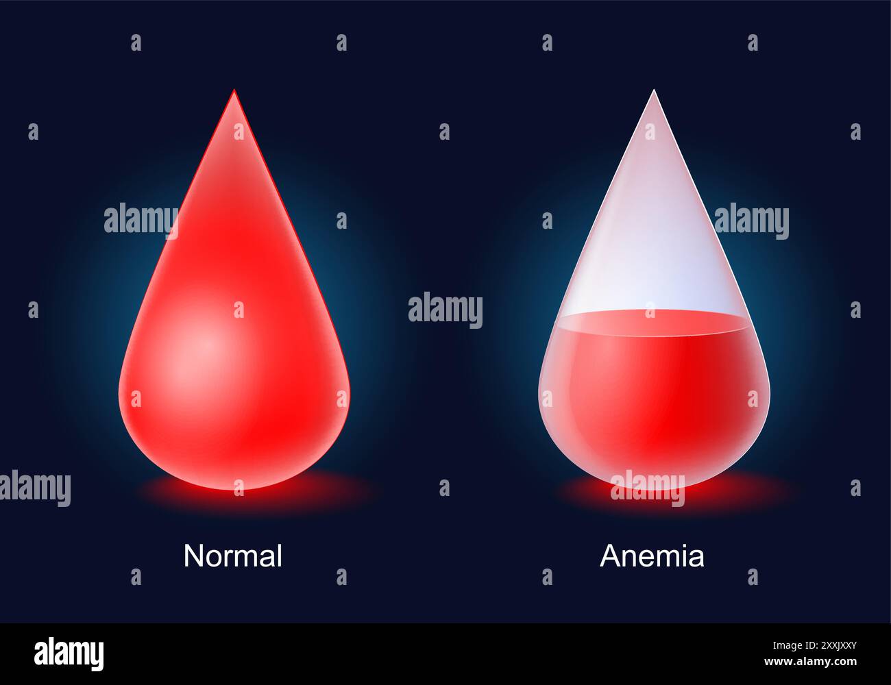 Anemia. Icone vettoriali sulle malattie del sangue. Forme gocce rosse con livello di sangue su sfondo scuro Illustrazione Vettoriale