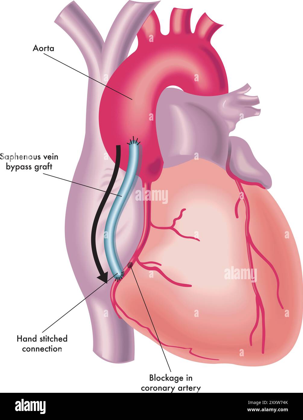 Illustrazione di un intervento chirurgico di bypass dell'arteria coronaria, con annotazioni. Illustrazione Vettoriale