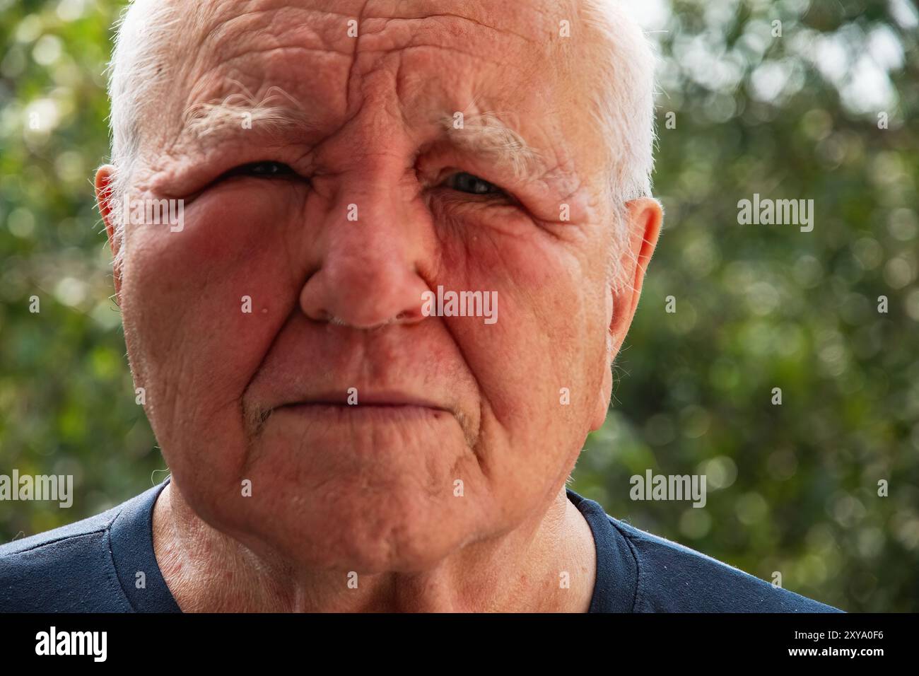 uomo con la faccia gonfia; reazione allergica al pokeweed Foto Stock